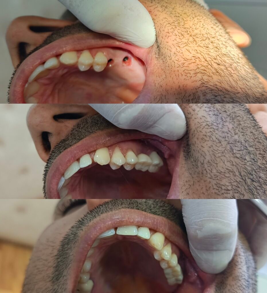 Implant dentaire. Dentolife Tunisie