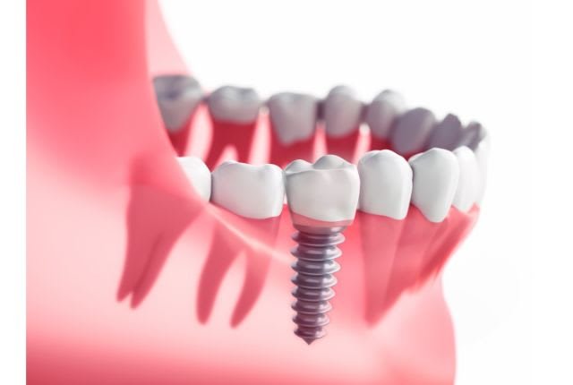 implant dentaire 2