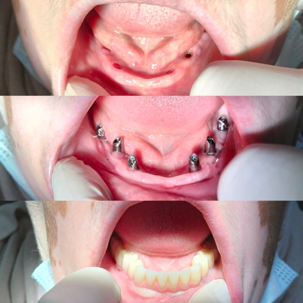 Implant dentaire Tunisie All-on-6 DentoLife