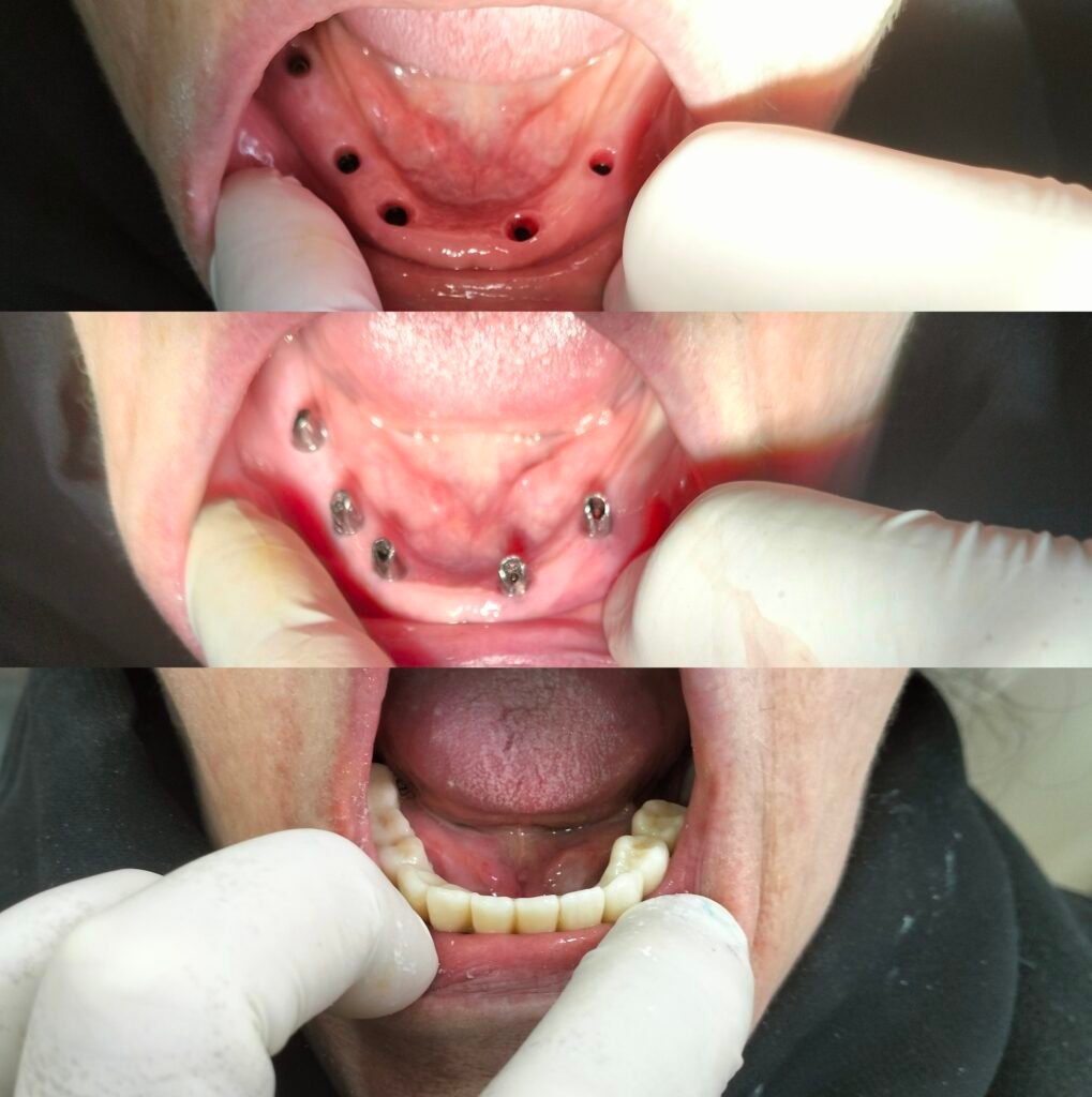 Implant dentaire Tunisie All-on-4 DentoLife