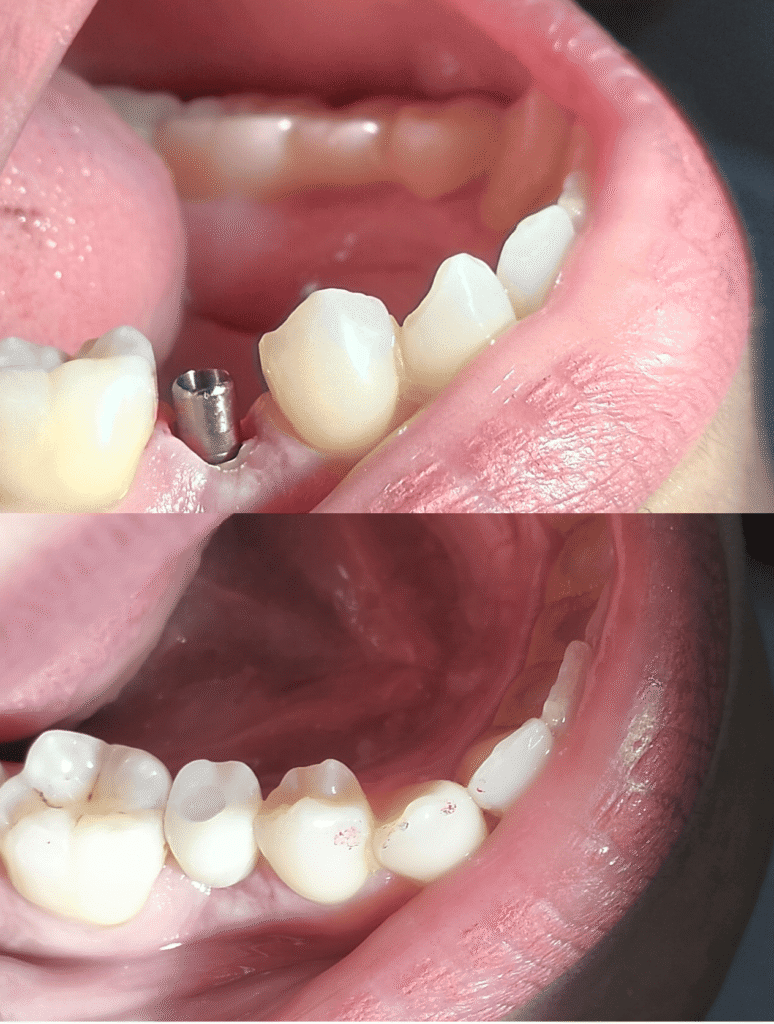 Implant dentaire. Dentolife Tunisie